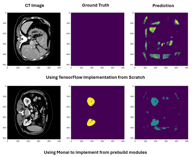 Kidney Tumor Segmentation